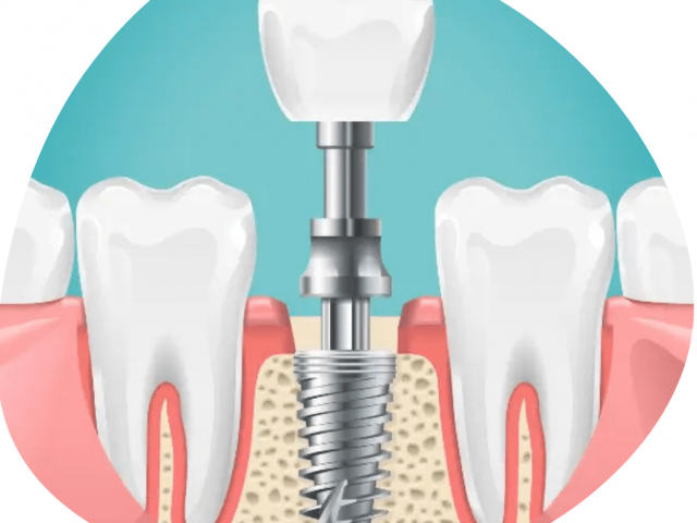 Untitled design (12) https://bridgeofdondental.co.uk/wp-content/uploads/2025/07/Untitled-design-12-e1753610559317-640x480.png